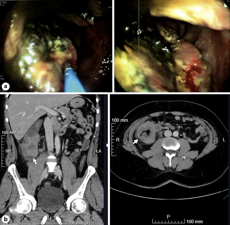 Long-Term Survival for Locally Advanced Adenosquamous Carcinoma Colon Cancer in Ulcerative Colitis: A Case Report.