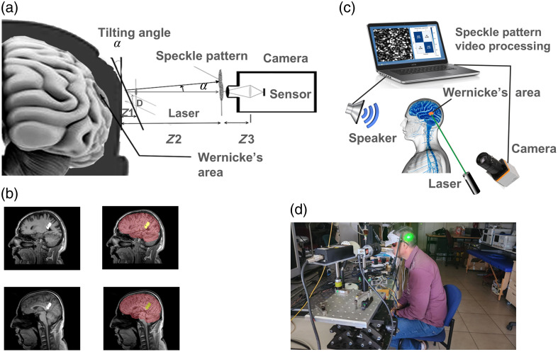 AI-powered remote monitoring of brain responses to clear and incomprehensible speech via speckle pattern analysis.
