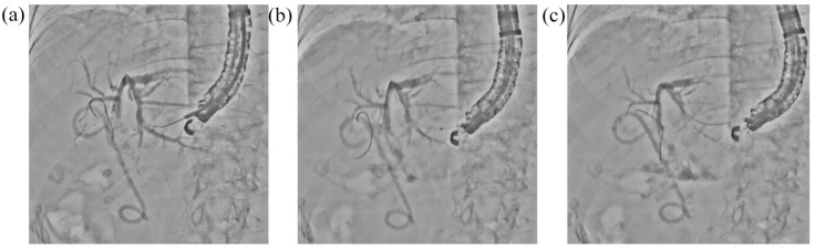 Clinical evaluation of a novel fluoroscopic mode for improving visibility during interventional endoscopic ultrasound (with video).