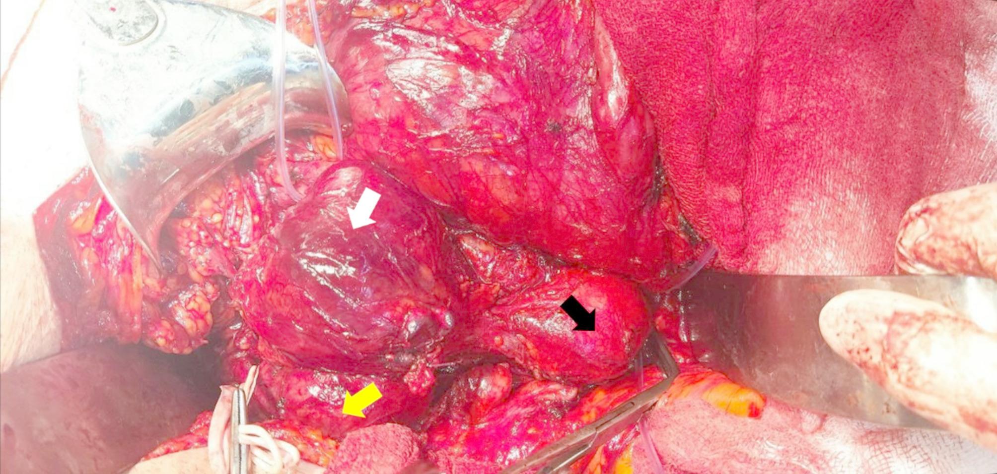 Unusual onset and presentation of isolated Uni-iliac aneurysm dissection in presence of aortoiliac aneurysms.