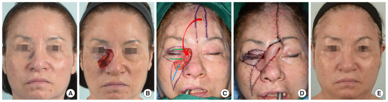 Reconstruction of large facial defects using three or more local flaps.
