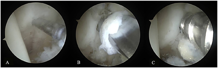 All-Inside Arthroscopic Brostrom Repair with Suture Tape Augmentation: A Technical Description.