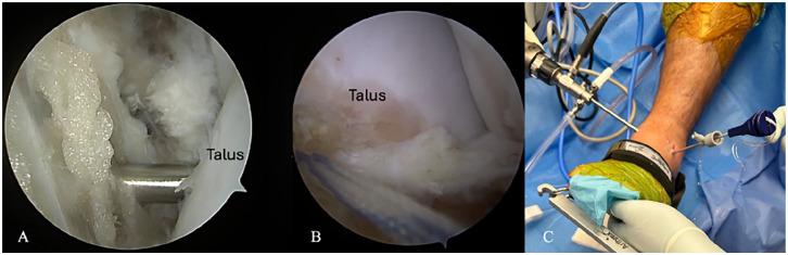All-Inside Arthroscopic Brostrom Repair with Suture Tape Augmentation: A Technical Description.