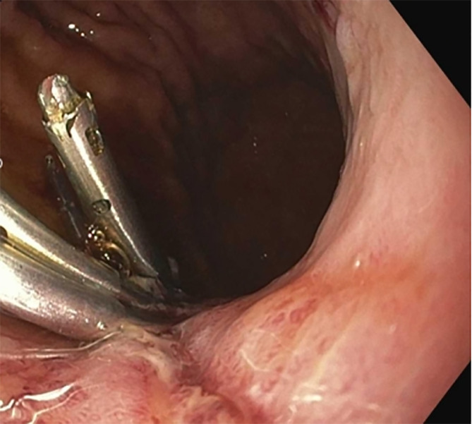 Efficacy and safety of single use duodenoscopes in comparison to reusable duodenoscopes for endoscopic retrograde cholangiopancreatography: A single center experience.