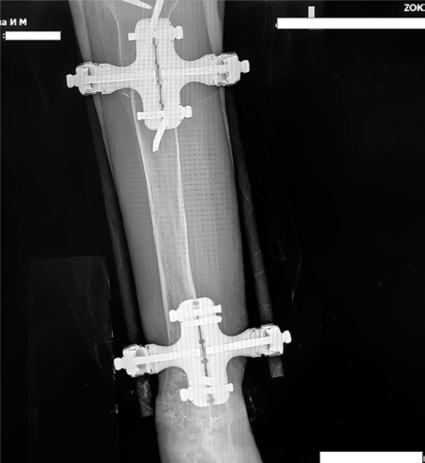 The use of regenerative technologies for treatment of delayed fracture union in patient with menopausal osteoporosis.