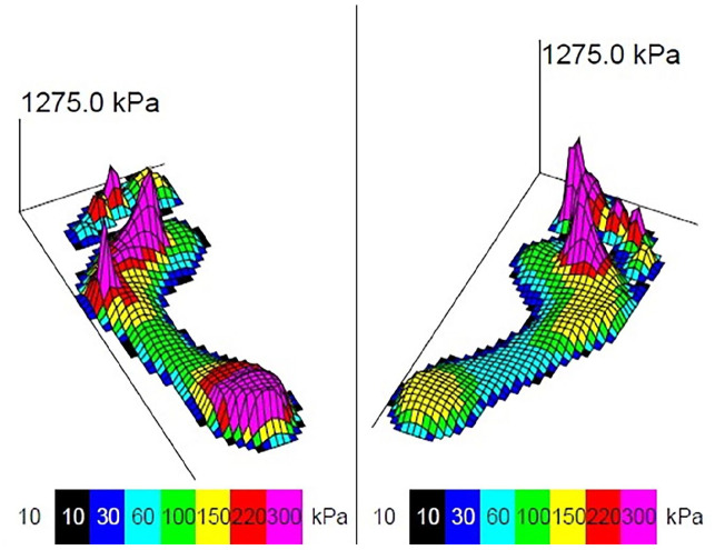 Compensatory Movements of the Midfoot Joints Influence Gait Pattern After Arthroscopic Ankle Arthrodesis.