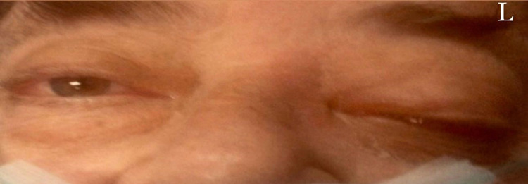 Treatment and Survival Outcomes in Rhino-Orbital Mucormycosis with and without Orbital Exenteration: A Retrospective Case Series and Literature Review.