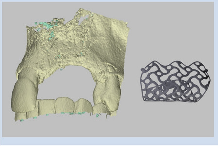Risk factors for dehiscence in alveolar ridge augmentation using patient-specific titanium mesh: a retrospective analysis.