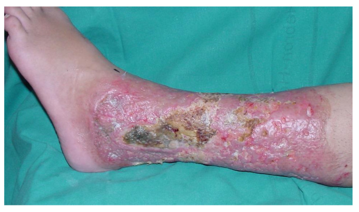 Anterolateral Thigh Flap for Acute/Primary Burn Reconstruction.