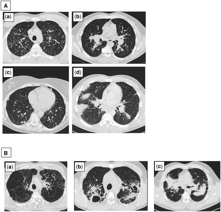 Radiological phenotypes in pulmonary sarcoidosis: a reliability study of newly defined high-resolution computer tomography phenotypes.
