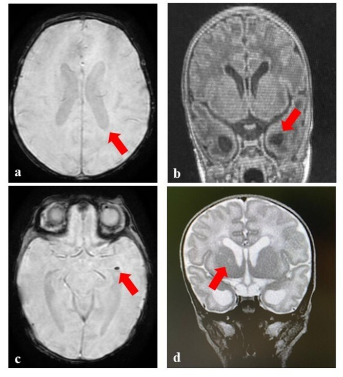 Congenital cytomegalovirus infection and brain injury in a newborn following maternal non-primary infection: case report of an unexpected diagnosis.