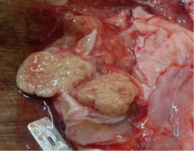 Giant Cystic Mucinous Borderline Tumour of the Ovary in a Young Female: A Rare Case Report.
