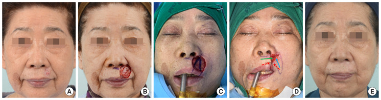 Reconstruction of large facial defects using three or more local flaps.