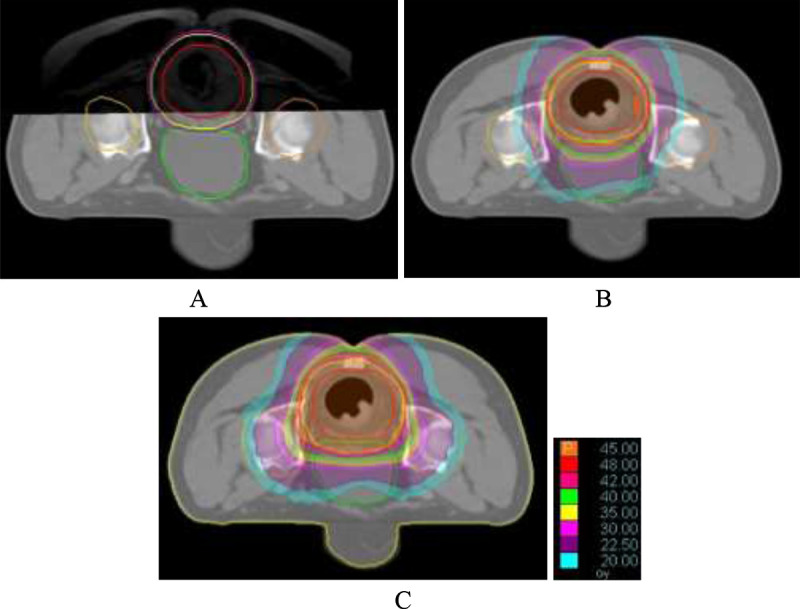 Evaluating the Effect of Co-Registered Diagnostic MR Images Based CT Simulation on Target Volume Delineation and Dose Distribution for Tomotherapy of Rectal Cancer.