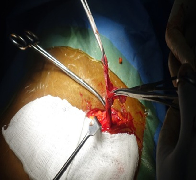 Hydrocele of the canal of Nuck mimicking an inguinal hernia in a 34-year-old pregnant woman: a case report.