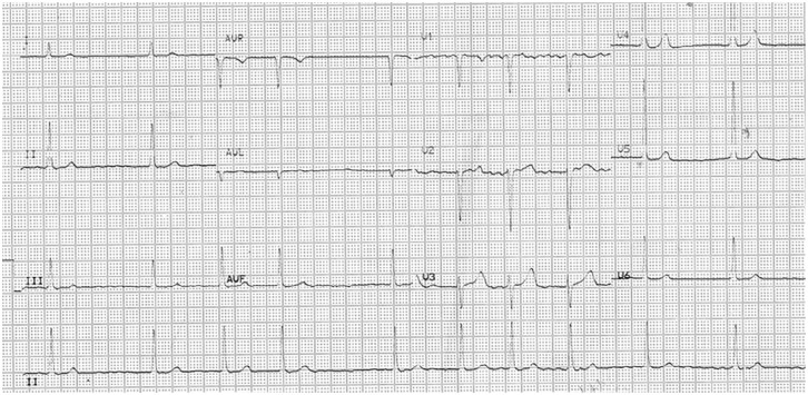 Atrial fibrillation with slow-ventricular response (AF-SVR): A literature review.