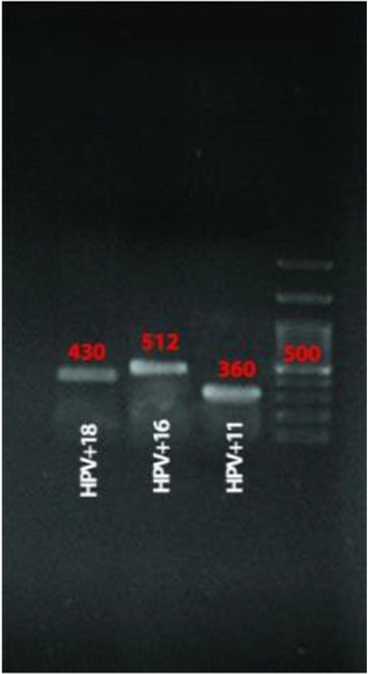 Design and comparison of PCR-ELISA reaction with other available hybridization methods to identify types 11, 16, and 18 of the human papillomavirus.