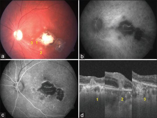 Clinical characteristics, imaging features, and fate of punctate outer retinal toxoplasmosis lesions in immunocompetent cases of ocular toxoplasmosis.