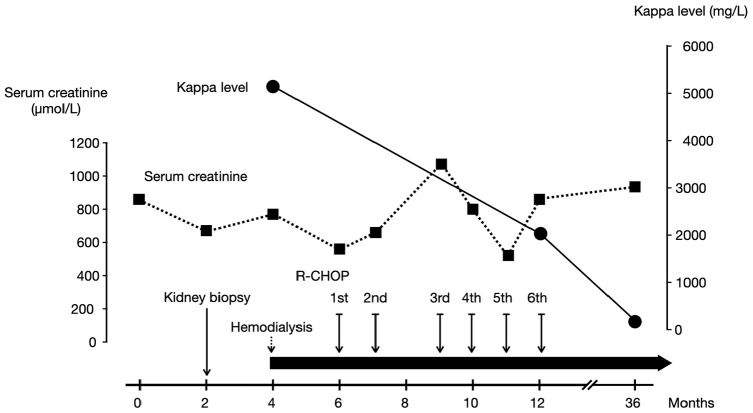 Extranodal Marginal Zone Lymphoma Presenting as Acute Kidney Injury due to Cast Nephropathy: A Case Report.