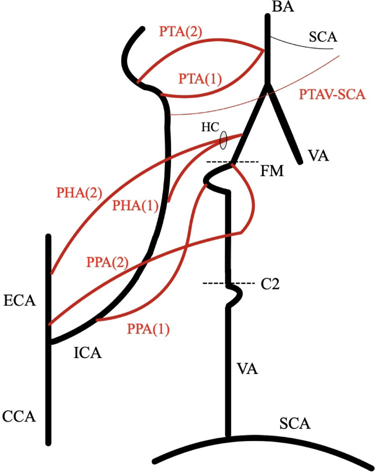 Persistent trigeminal artery variant functioning as a duplicate superior cerebellar artery.