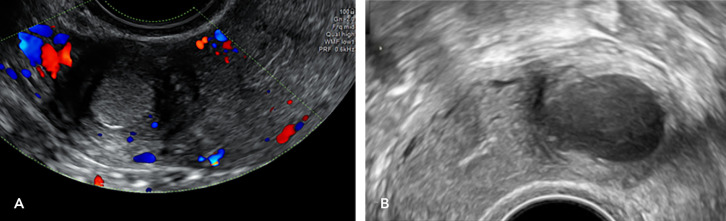 Euro-Chinese consensus on accessory cavitated uterine malformation<sup>*,†</sup>.