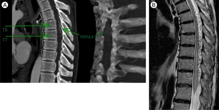 Successful treatment of rapid onset Foix-Alajouanine syndrome following hyperselective endovascular embolization of thoracic dural arteriovenous fistula: Case report, technical note and literature review.