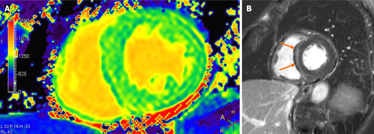 Diagnostic usefulness and limitation of cardiac magnetic resonance for identifying myocardial damage in survivors of cardiac arrest in midtown.