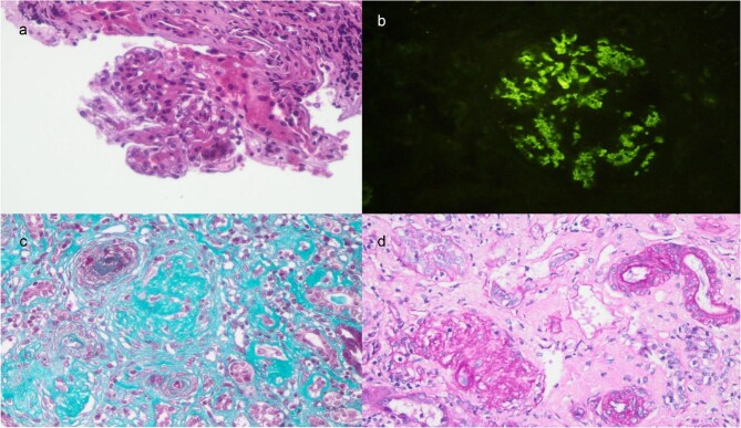 C-terminal <i>TREX1</i> c.914A>G variant in a patient with IgA nephropathy and thrombotic microangiopathy: expanding the clinical and genetic spectrum of IgA nephropathy with microangiopathic lesions.