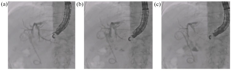 Clinical evaluation of a novel fluoroscopic mode for improving visibility during interventional endoscopic ultrasound (with video).