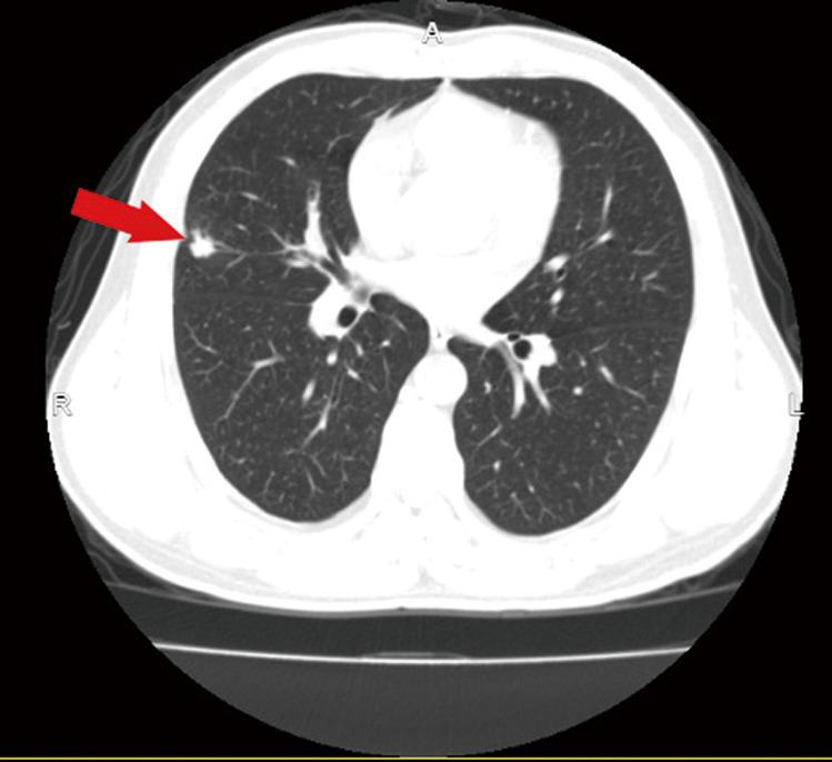 Surgical treatment of IIIb (N2), ROS1(+) non-small cell lung cancer after neoadjuvant chemotherapy combined with targeted therapy: a case report.