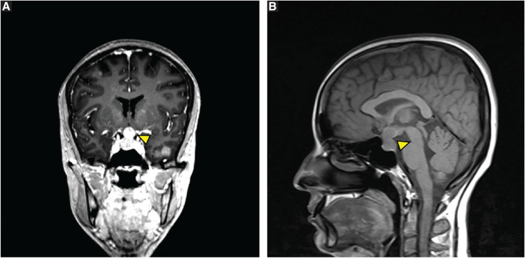 Endocrine manifestations of lung adenocarcinoma with epidermal growth factor receptor mutation mimicking tuberculosis: A case report and literature review.