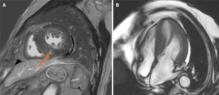 Diagnostic usefulness and limitation of cardiac magnetic resonance for identifying myocardial damage in survivors of cardiac arrest in midtown.