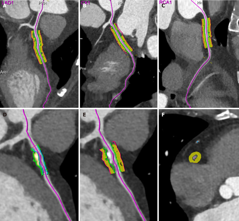 Computed tomography-based assessment of pericoronary adipose tissue in cardiovascular diseases: Diagnostic and prognostic implications.