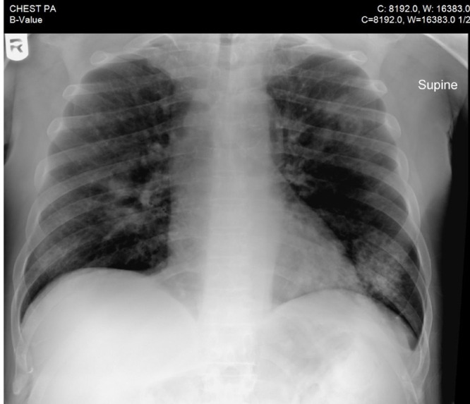 Treatment and Survival Outcomes in Rhino-Orbital Mucormycosis with and without Orbital Exenteration: A Retrospective Case Series and Literature Review.