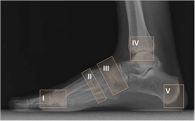 Management of hindfoot and ankle in Charcot arthropathy.