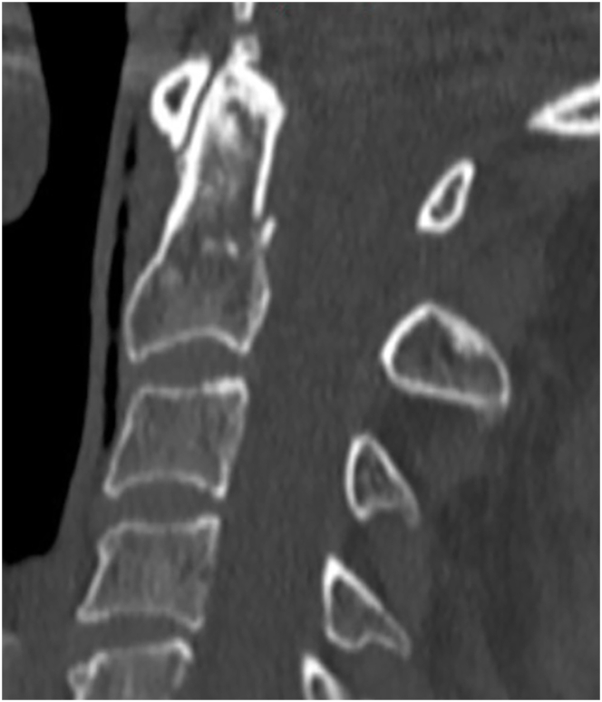 Treatment practices for geriatric type II odontoid fractures - A survey by the European Association of Neurosurgical Societies Spine Section.