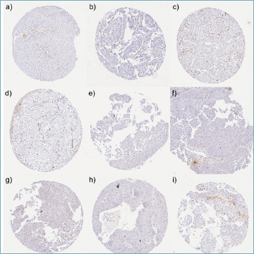 KDM6A expression loss is frequent in low grade non-invasive urothelial carcinomas of the urinary bladder.
