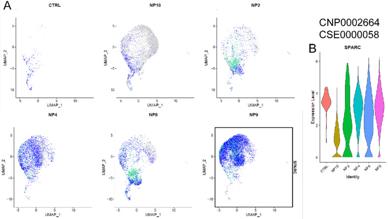 Molecular Mechanisms of Intervertebral Disc Degeneration: Significance of SPARC Gene Expression.