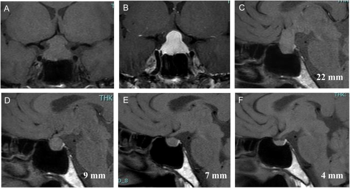 Development of Graves' disease in a patient with lymphocytic hypophysitis following glucocorticoid treatment.