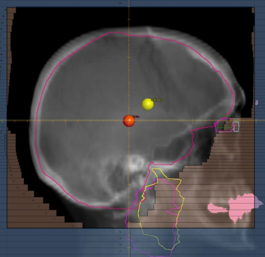 Dosimetric analysis of different whole brain radiotherapy treatment planning methods: three types of 3-dimensional versus hippocampal avoidant.