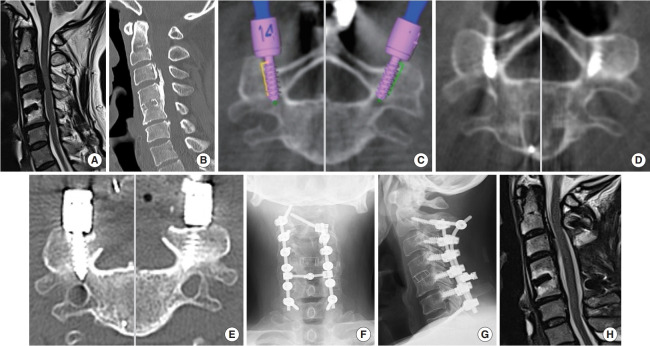Optimization of Paravertebral Foramen Screw Placement: A Stepwise Approach Considering O-arm Navigation Errors: Technical Note and Case Series.