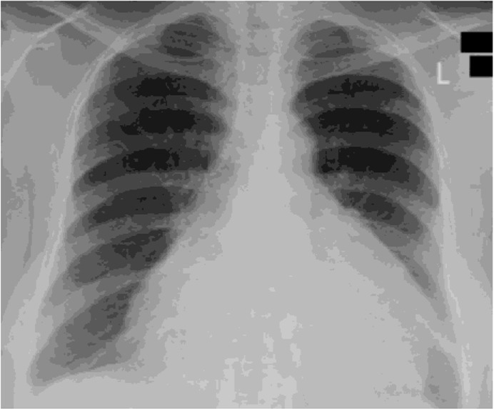 Heavy hearts: the impact of influenza on young lives, a rare case report.