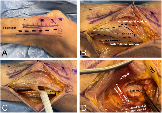 Posterolateral tibia plateau fractures: pros and cons of different surgical approaches.
