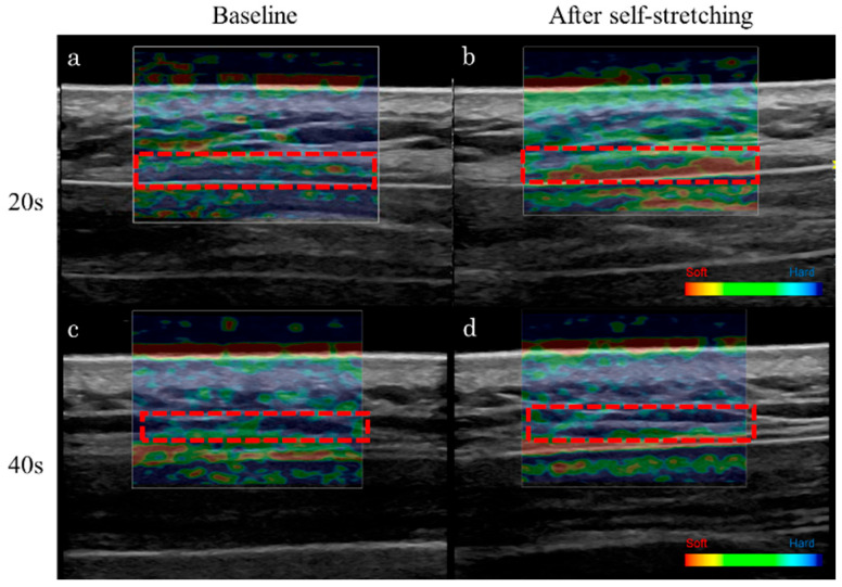 Effects of Trapezius Muscle Self-Stretching on Muscle Stiffness and Choroidal Circulatory Dynamics: An Evaluation Using Ultrasound Strain Elastography and Laser Speckle Flowgraphy.