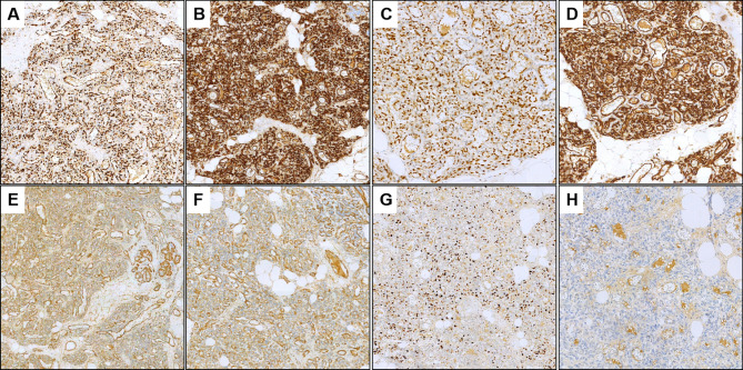 Large atypical perilobular hemangioma in the breast: a potential misdiagnosis as angiosarcoma.