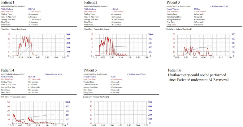 Transurethral Sphincterotomy and an Artificial Urinary Sphincter - A Novel 2-Stage Surgery for Refractory Bladder Emptying Disorders: A Proof-of-Concept Study.