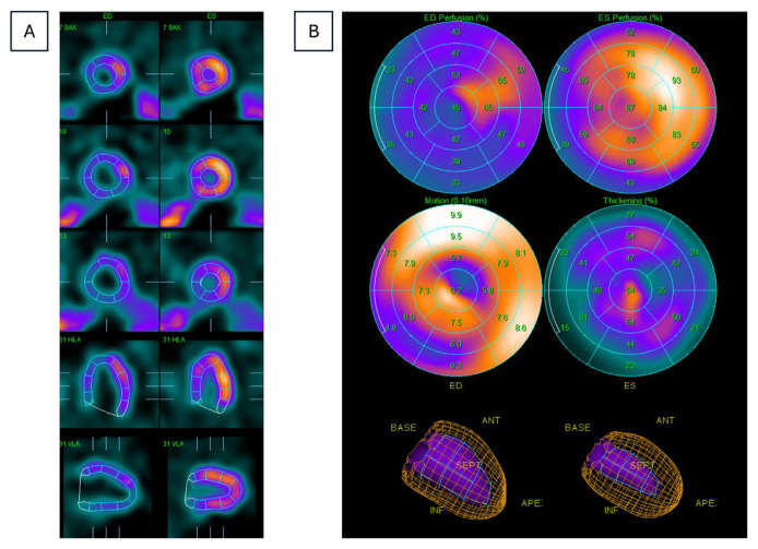 Unmasking Myocardial Bridging: Multimodal Imaging and Tailored Medical Approach in Exercise-induced Angina - A Case Report.