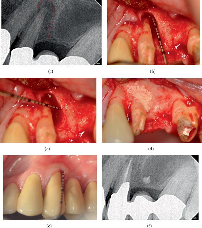 Long-Term Benefits of Periodontal Regeneration in Severely Compromised Teeth: A Retrospective Case Series.