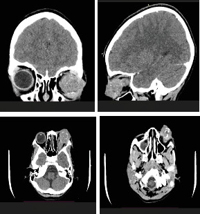 Retinoblastoma in a Young Nigerian Girl: A Case Report From ECWA Eye Hospital, Kano.