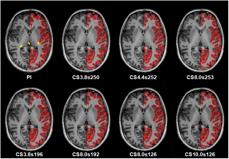 Shortening 7T MP2RAGE acquisition with compressed sensing: Evaluating quantitative accuracy and structural consistency.